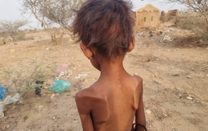 طفل يعاني من سوء التغذية في مخيمات النزوح بعبس ـ تصوير: عيسى راجح