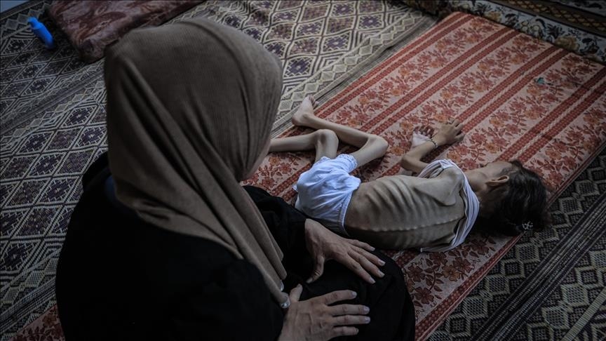 طفل غزاوي من ضحايا التجويع الإسرائيلي ـ الاناضول