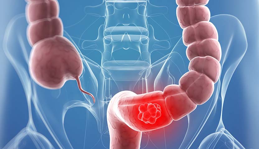 بعض الأطعمة قد تسبب سرطان القولون.. دراسة تكشف ذلك