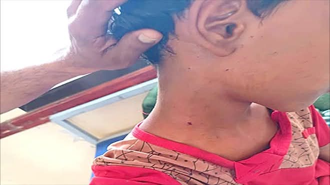 لحج.. إصابة طفل برصاص مليشيا الحوثي شمال المحافظة